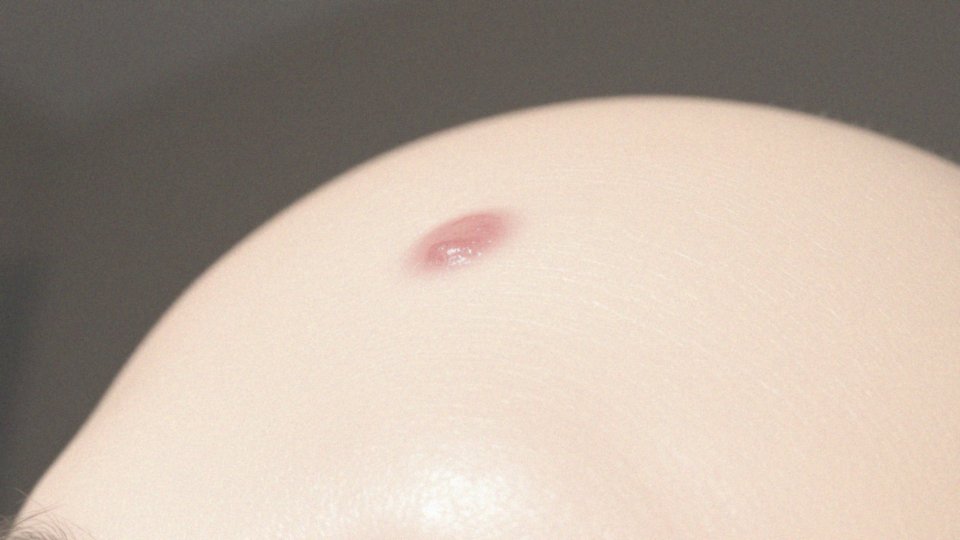 Jakie są najczęstsze objawy guza na czole?